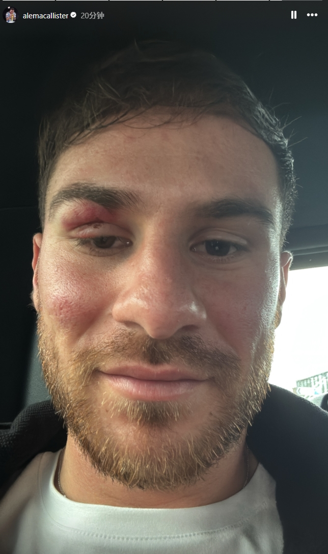  痛并快樂著！麥卡利斯特封堵馬爾穆什射門后“破相”，但心情不錯