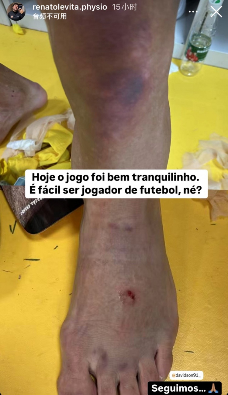  西海岸理療師曬戴維森腿部傷勢(shì)照：當(dāng)足球運(yùn)動(dòng)員很容易，對(duì)吧？