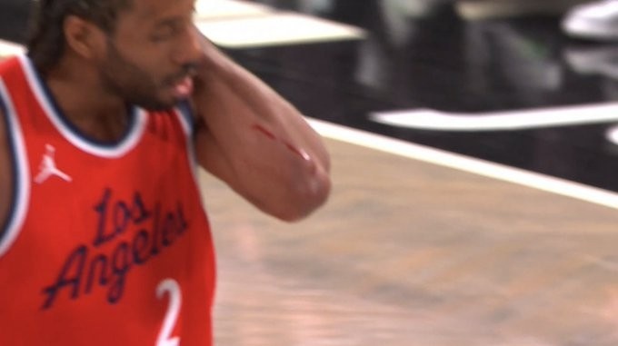  觸目驚心！小卡手臂被劃出一道長長的血痕 去場邊及時(shí)止血處理